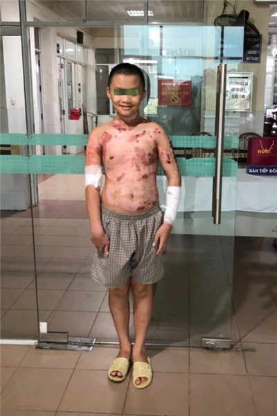 Điều trị thành công bệnh nhân trẻ em bỏng rộng bị suy tuyến yên, suy tuyến giáp, sốc bỏng nặng